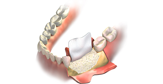 L'extraction dentaire – préservation osseuse avant la mise en place d'un  implant dentaire Le Perreux sur Marne (94170)