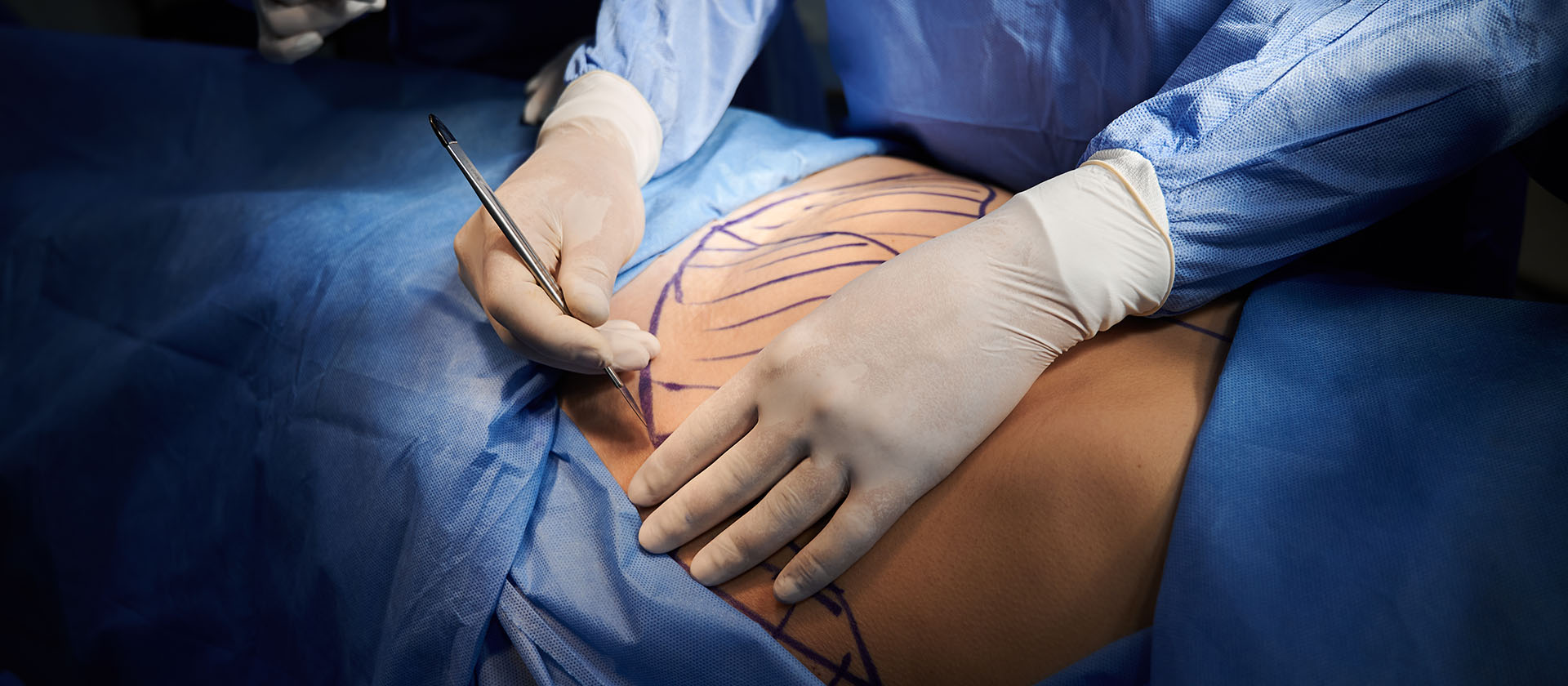 Abdominoplastie : chirurgie du ventre chez l'homme à Paris